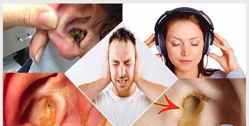 Bệnh lý dẫn đến u tai