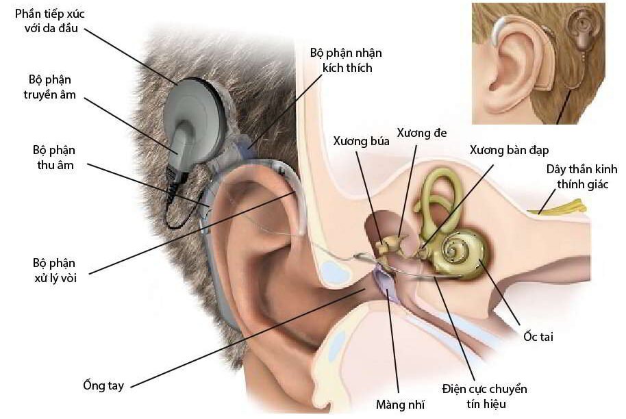 Cấu tạo hệ thống ốc tai điện tử