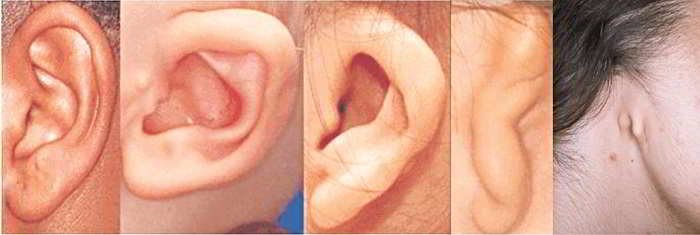 Dị dạng vành tai, ống tai