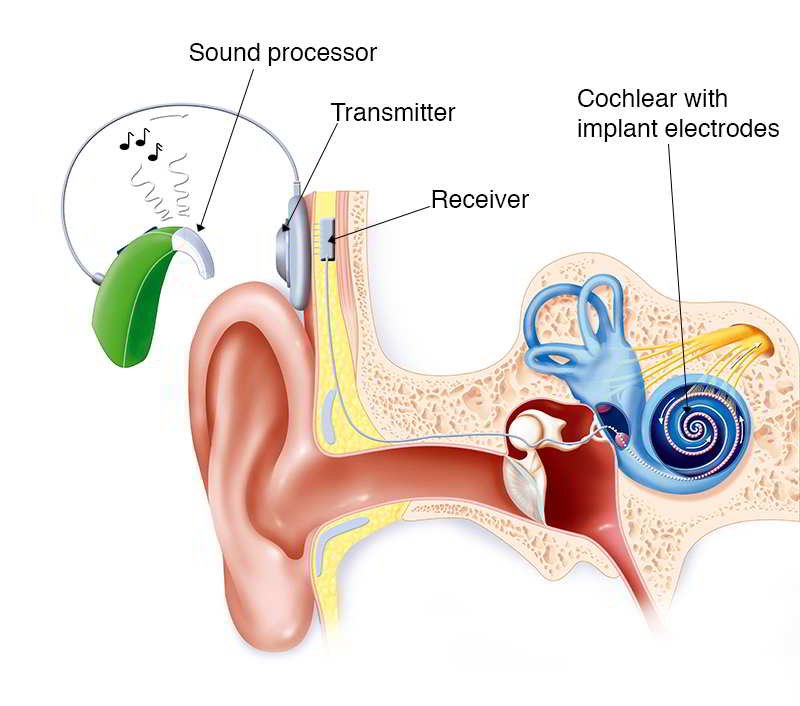 Cấy ghép ốc tai điện tử